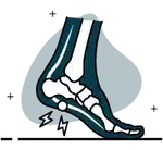 Fasceite Plantar