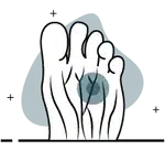 Neuroma de Morton